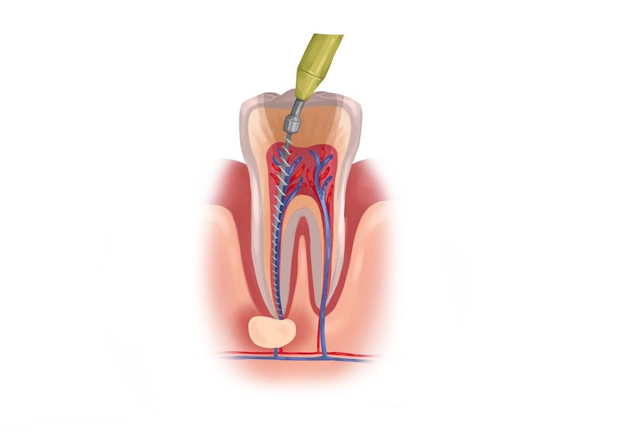 Drawing of root canal therapy