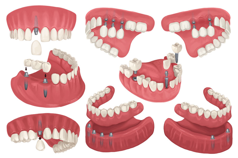 Drawing of various configurations for dental implants to replace missing teeth