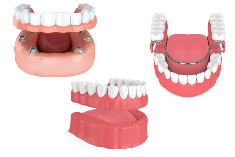 Drawings of overdentures, full dentures, and partial dentures in Henderson, NV, to replace missing teeth