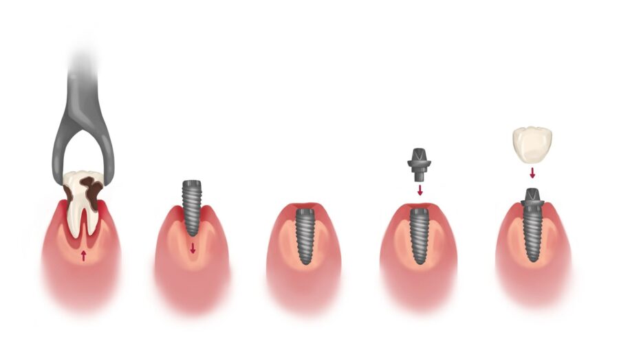 dental implants, implant timeline, tooth restoration, dental implant process, dental crown, Henderson dentist