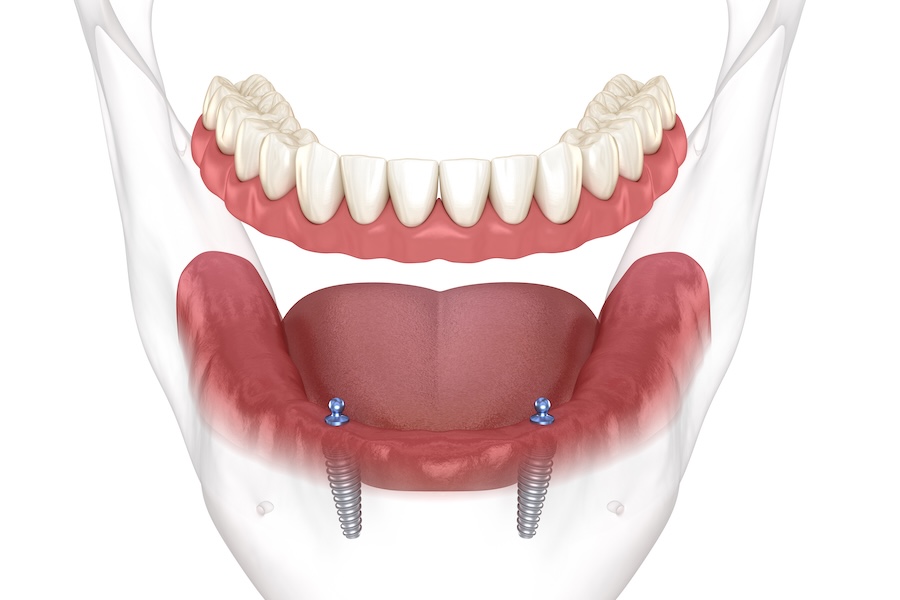 mandibular overdenture